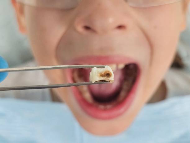 Best Emergency Wisdom Tooth Extraction in Wood River, IL