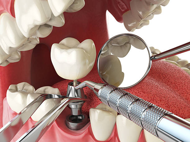 Best Emergency Root Canal Therapy in Wood River, IL